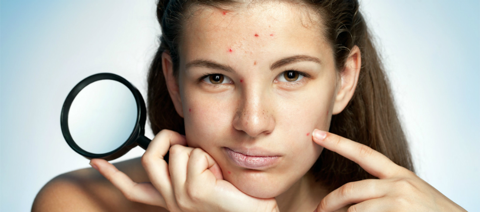 Cuidados para la piel con acné