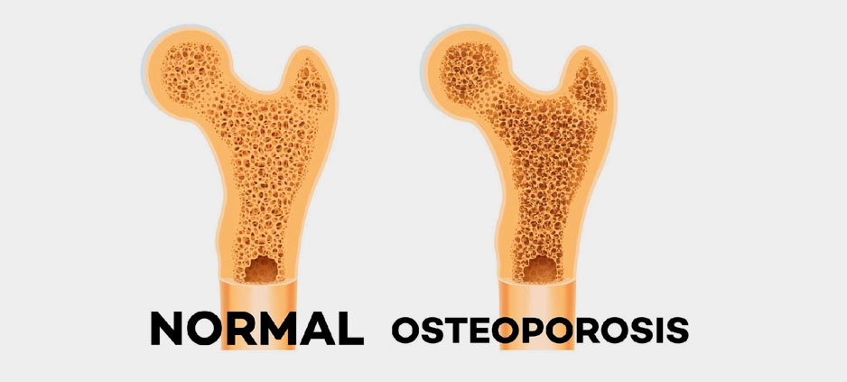 Cuidémonos de la osteoporosis
