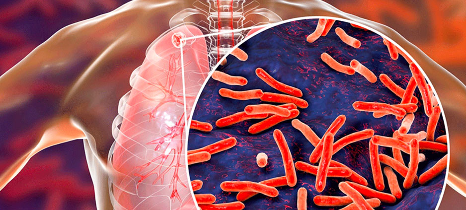 programa-tuberculosis